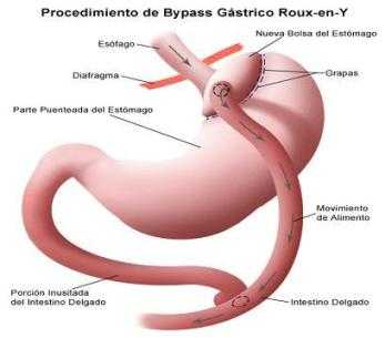 bypass