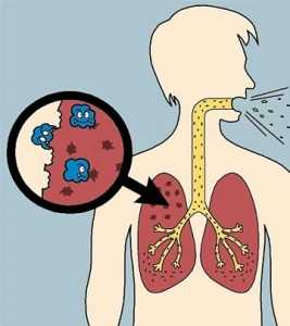 tuberculosis