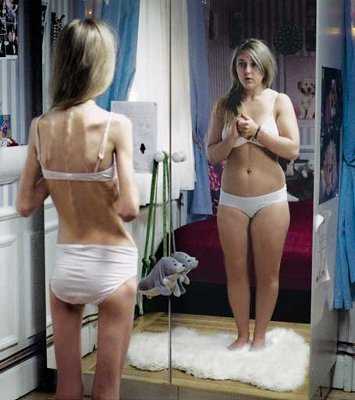 anorexia